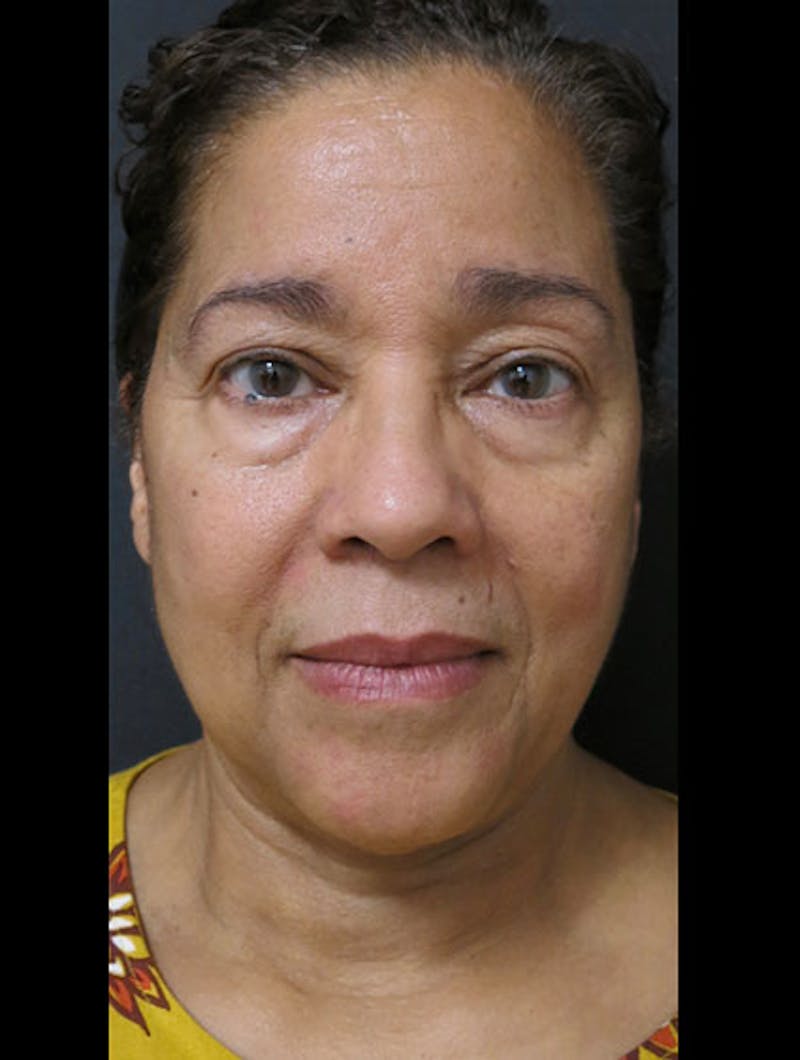 Face & Neck Lift Before & After Gallery - Patient 122909011 - Image 1