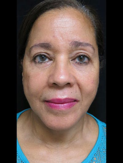 Face & Neck Lift Before & After Gallery - Patient 122909011 - Image 2