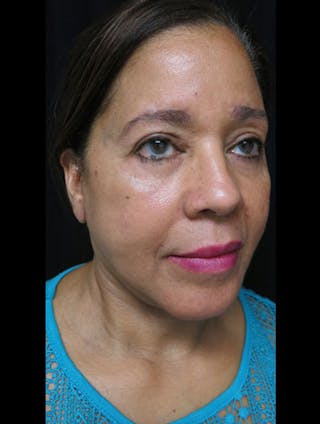 Face & Neck Lift Before & After Gallery - Patient 122909011 - Image 4