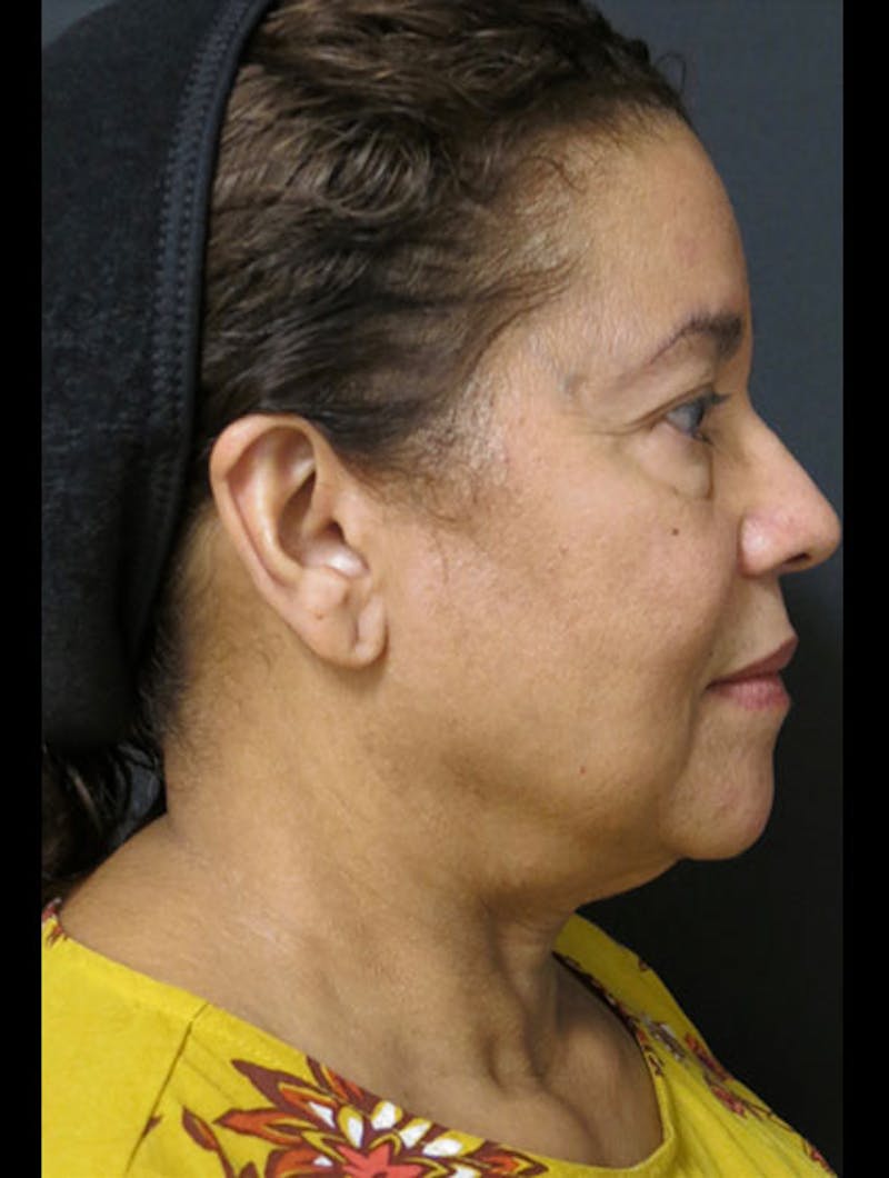 Face & Neck Lift Before & After Gallery - Patient 122909011 - Image 5