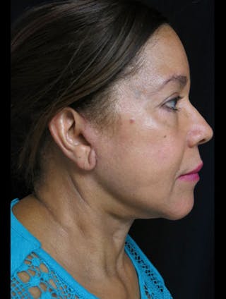 Face & Neck Lift Before & After Gallery - Patient 122909011 - Image 6