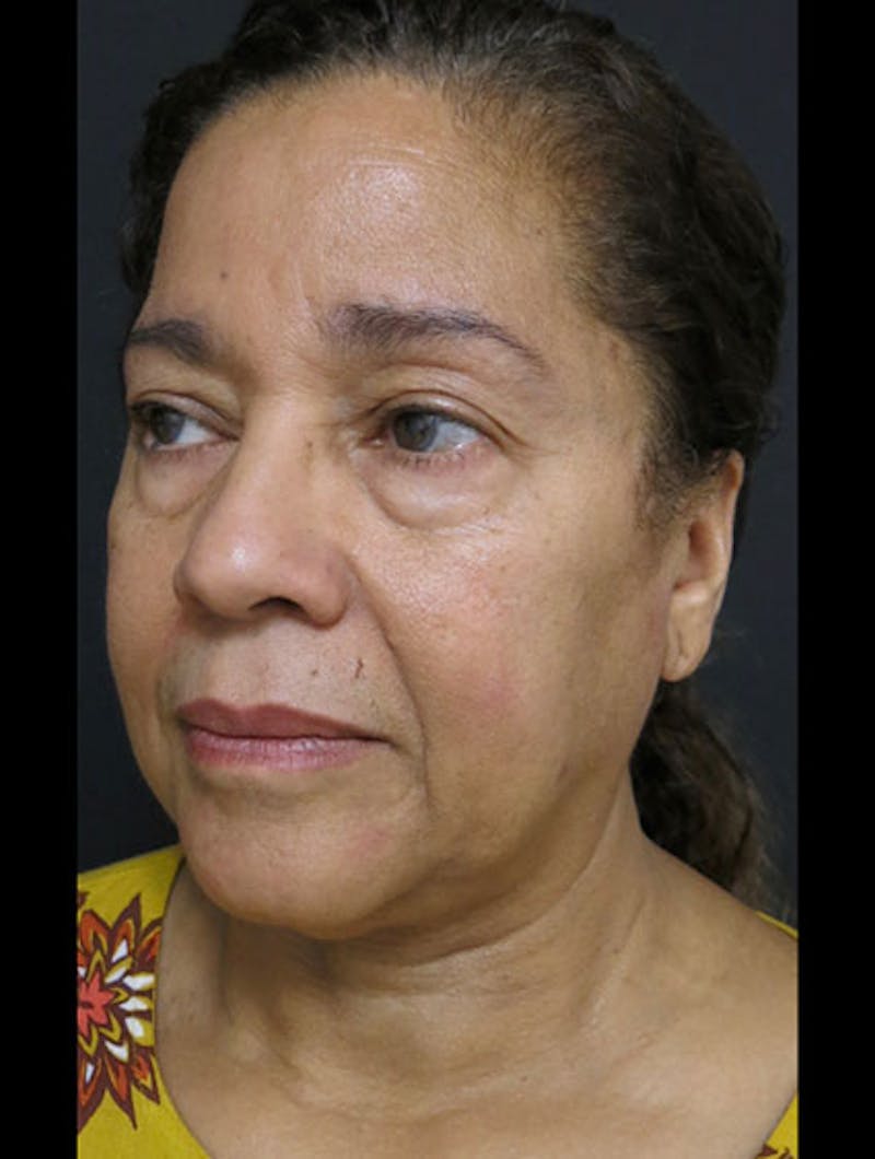 Face & Neck Lift Before & After Gallery - Patient 122909011 - Image 7