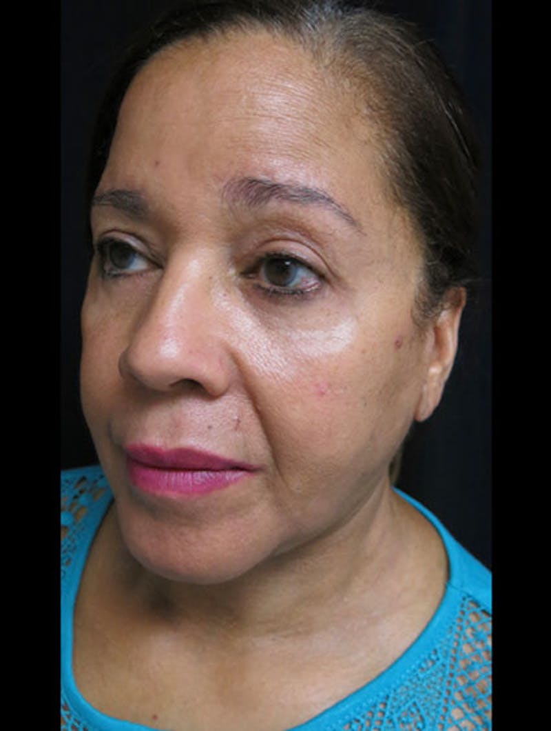 Face & Neck Lift Before & After Gallery - Patient 122909011 - Image 8