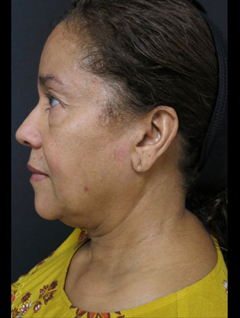 Face & Neck Lift Before & After Gallery - Patient 122909011 - Image 9
