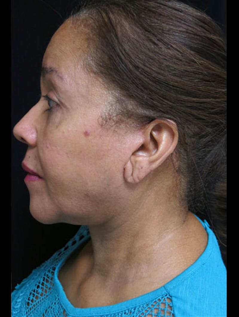 Face & Neck Lift Before & After Gallery - Patient 122909011 - Image 10