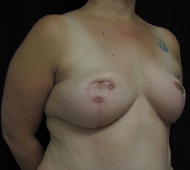 Breast Reconstruction Before & After Gallery - Patient 410029 - Image 5