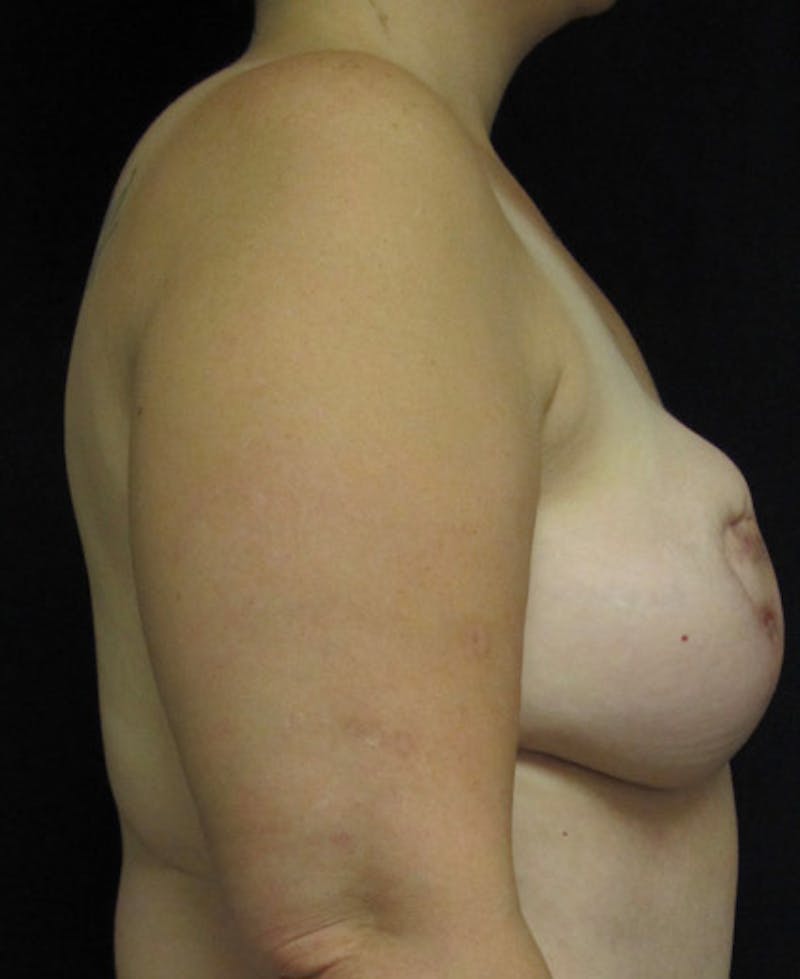 Breast Reconstruction Before & After Gallery - Patient 410029 - Image 7