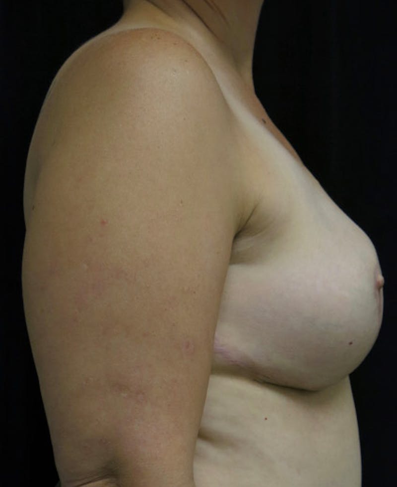Breast Reconstruction Before & After Gallery - Patient 122909018 - Image 8