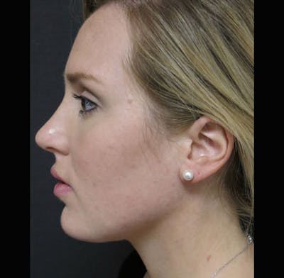 Chin Before & After Gallery - Patient 122909048 - Image 2