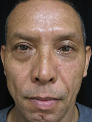 Scar Revision Before & After Gallery - Patient 754538 - Image 2