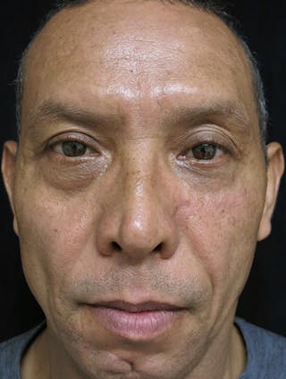 Scar Revision Before & After Gallery - Patient 122909044 - Image 2