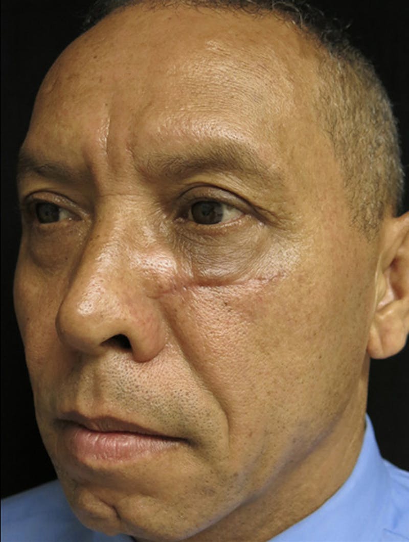 Scar Revision Before & After Gallery - Patient 122909044 - Image 3