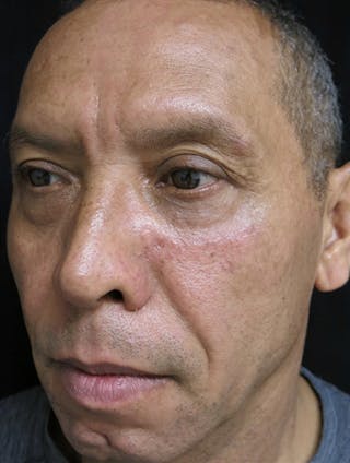 Scar Revision Before & After Gallery - Patient 122909044 - Image 4