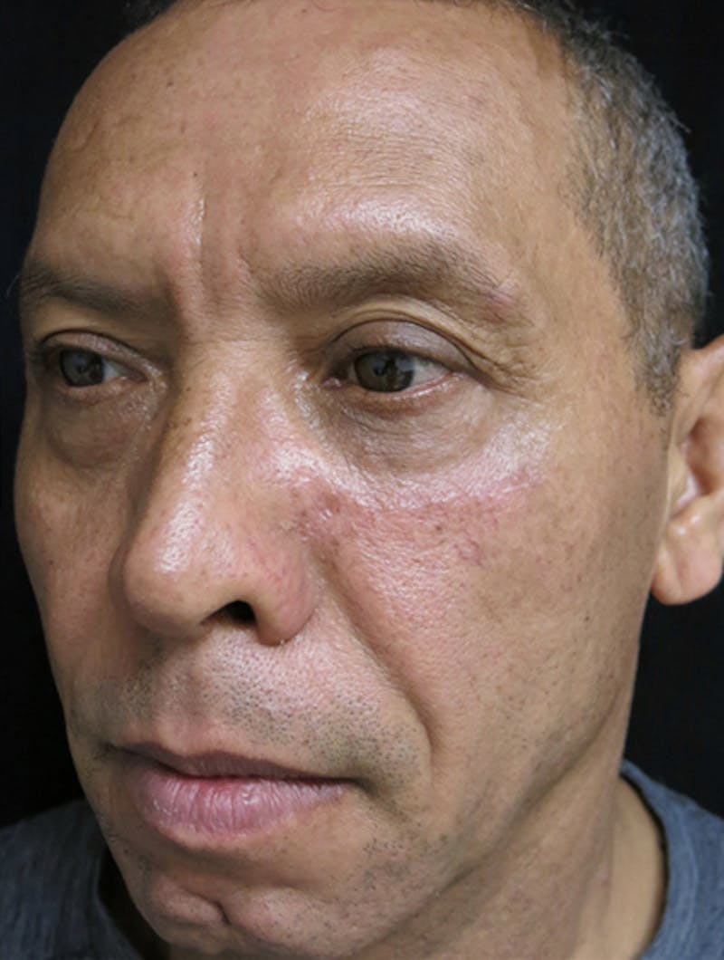 Scar Revision Before & After Gallery - Patient 122909044 - Image 4