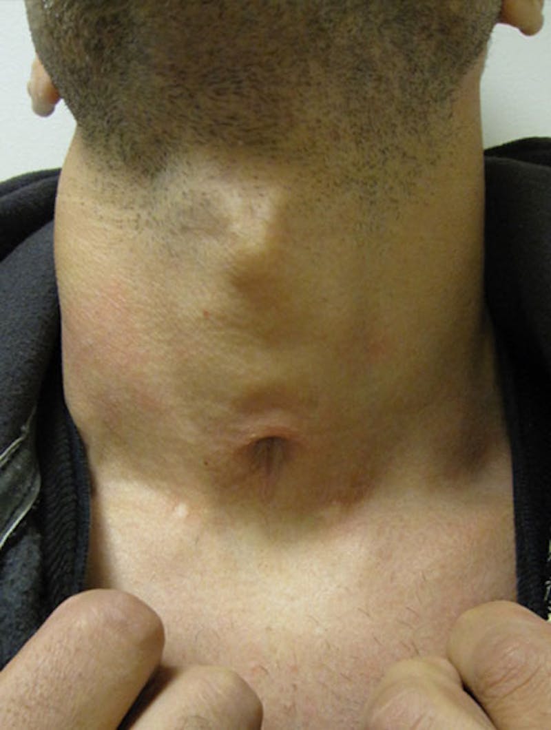 Scar Revision Before & After Gallery - Patient 357044 - Image 1