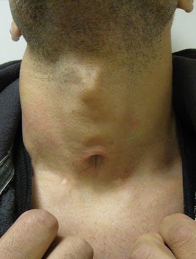Scar Revision Before & After Gallery - Patient 122909046 - Image 1