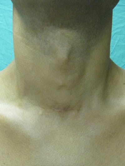 Scar Revision Before & After Gallery - Patient 357044 - Image 2