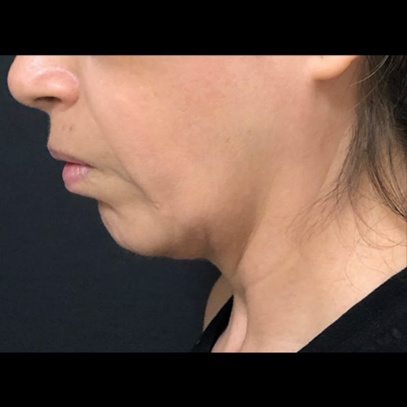 Chin Before & After Gallery - Patient 122909051 - Image 1