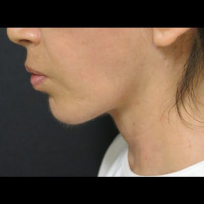 Chin Before & After Gallery - Patient 122909051 - Image 2