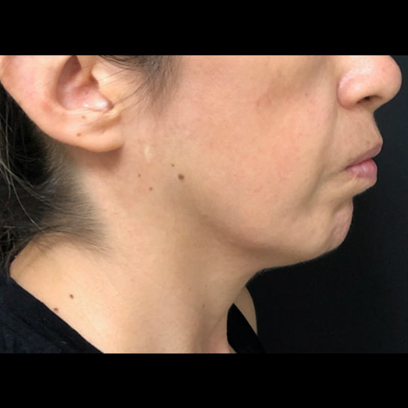 Chin Before & After Gallery - Patient 122909051 - Image 3