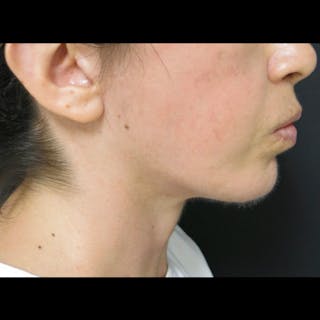 Chin Before & After Gallery - Patient 122909051 - Image 4
