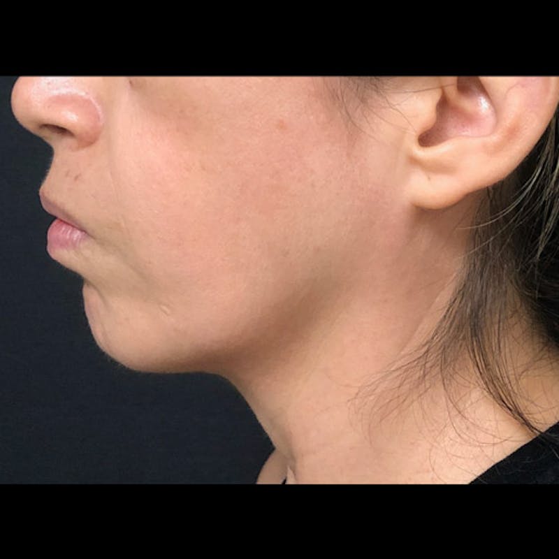 Chin Before & After Gallery - Patient 122909051 - Image 5