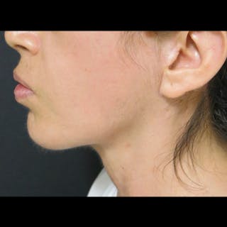 Chin Before & After Gallery - Patient 122909051 - Image 6