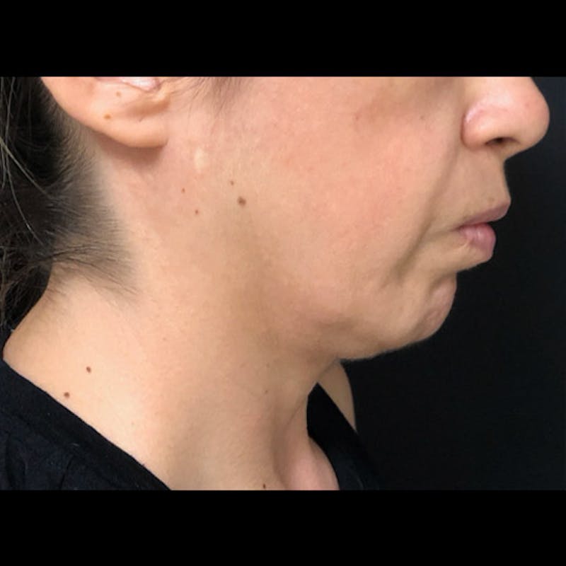 Chin Before & After Gallery - Patient 122909051 - Image 7