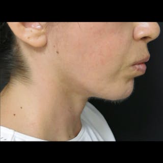 Chin Before & After Gallery - Patient 122909051 - Image 8