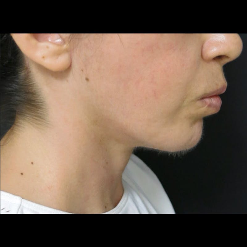 Chin Before & After Gallery - Patient 122909051 - Image 8