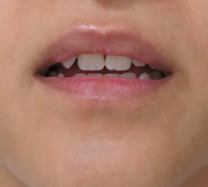 Facial Fat Grafting Before & After Gallery - Patient 122909056 - Image 3