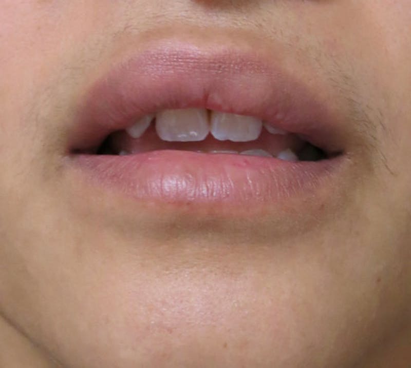 Facial Fat Grafting Before & After Gallery - Patient 122909056 - Image 4