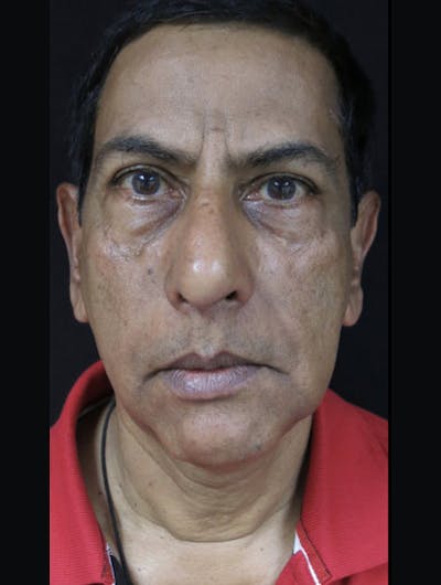 Facial Fat Grafting Before & After Gallery - Patient 122909070 - Image 1