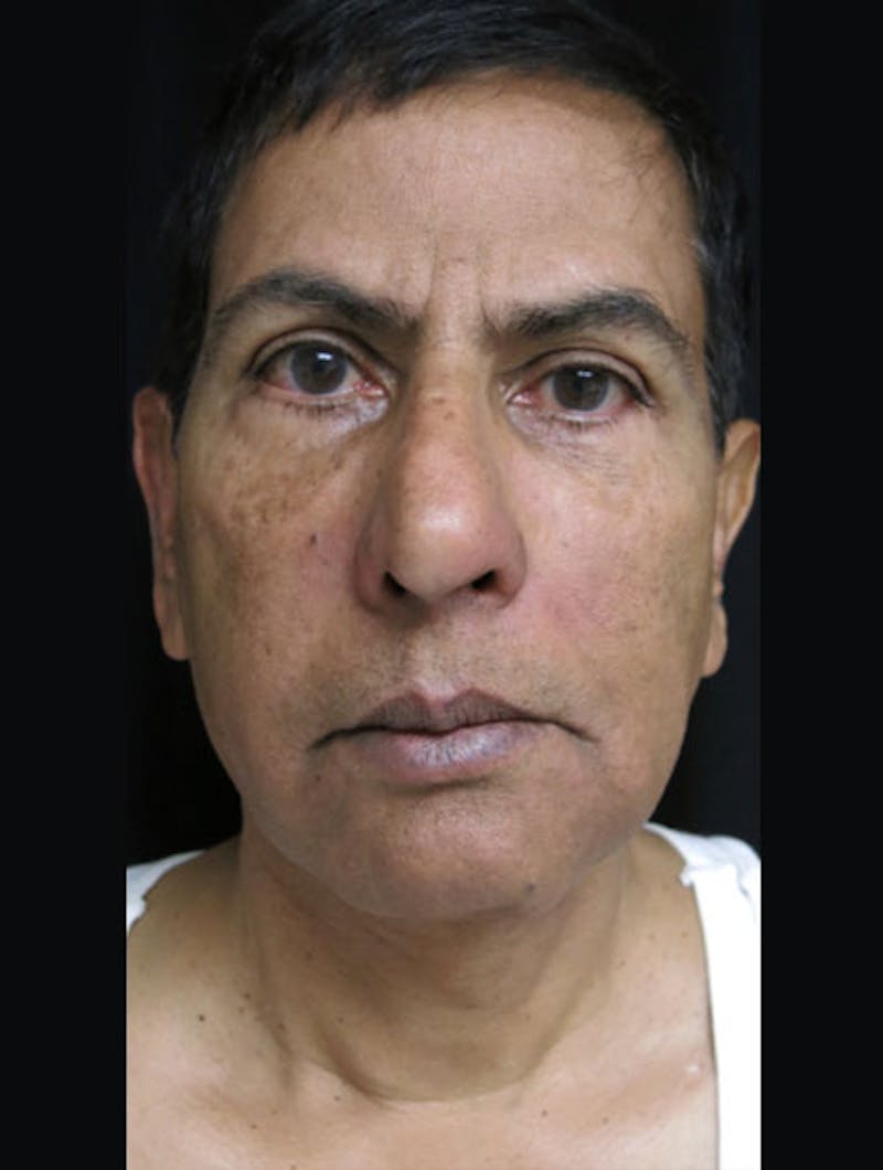 Facial Fat Grafting Before & After Gallery - Patient 122909070 - Image 2