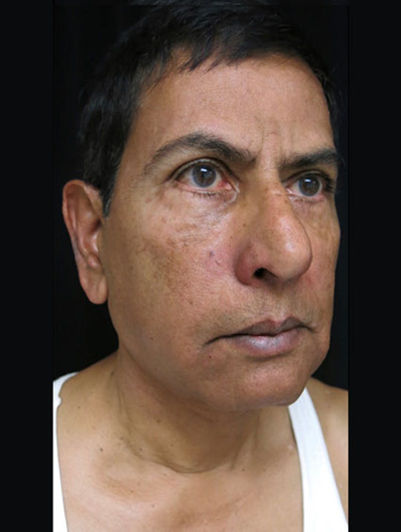 Facial Fat Grafting Before & After Gallery - Patient 122909070 - Image 4