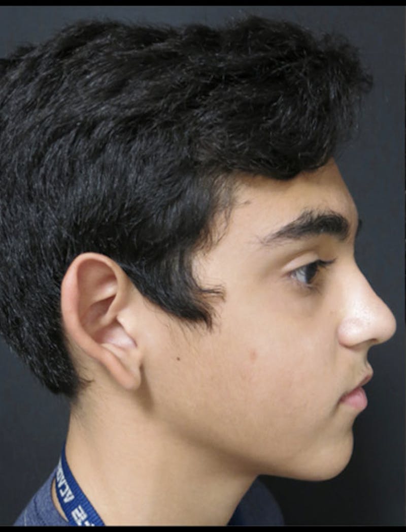 Otoplasty Ear Pinning Before & After Gallery - Patient 122909063 - Image 7
