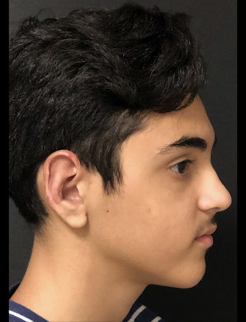 Otoplasty Ear Pinning Before & After Gallery - Patient 122909063 - Image 8