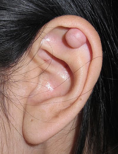Ear Lobe Repair and Ear Reconstruction Before & After Gallery - Patient 122909065 - Image 1