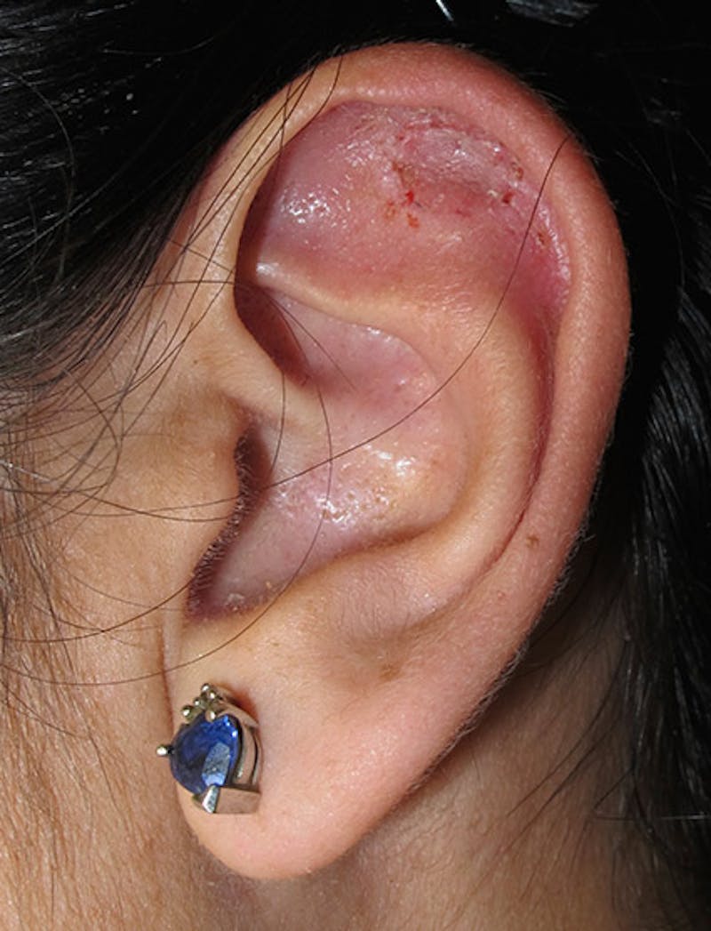 Ear Lobe Repair and Ear Reconstruction Before & After Gallery - Patient 122909065 - Image 2