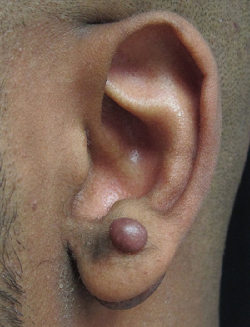 Ear Lobe Repair and Ear Reconstruction Before & After Gallery - Patient 122909079 - Image 1