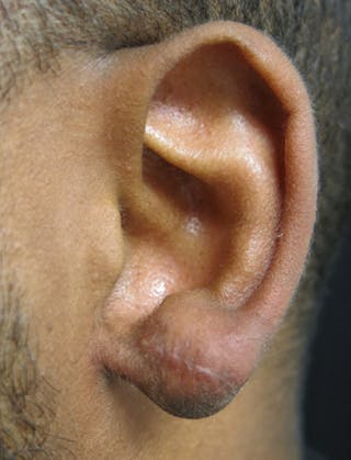 Ear Lobe Repair and Ear Reconstruction Before & After Gallery - Patient 122909079 - Image 2