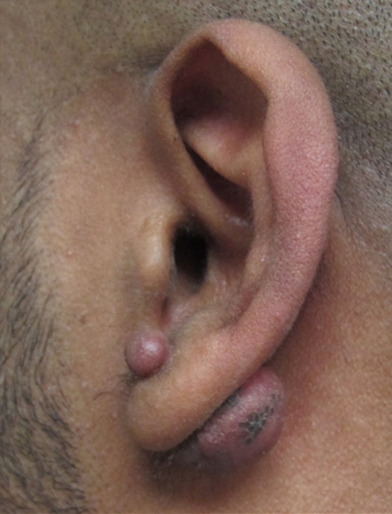 Ear Lobe Repair and Ear Reconstruction Before & After Gallery - Patient 122909079 - Image 3