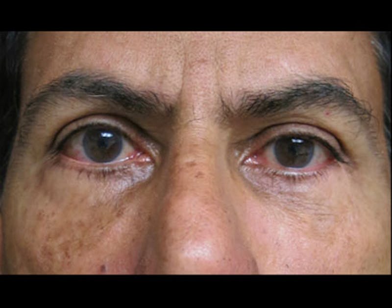 Facial Fat Grafting Before & After Gallery - Patient 122909071 - Image 2
