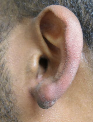 Ear Lobe Repair and Ear Reconstruction Before & After Gallery - Patient 122909079 - Image 4