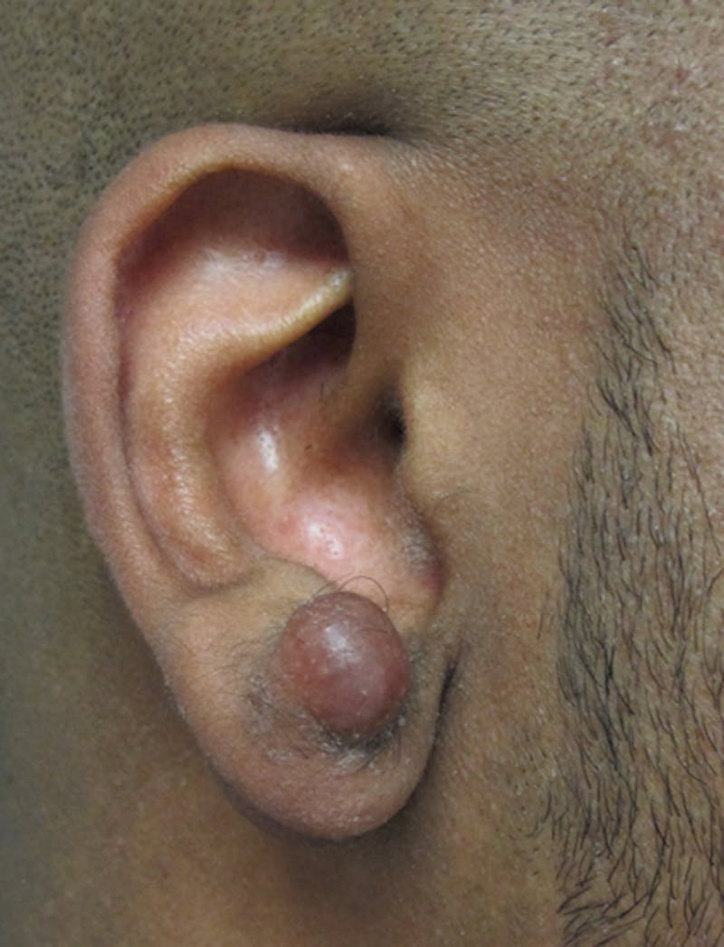 Ear Lobe Repair and Ear Reconstruction Before & After Gallery - Patient 122909079 - Image 5