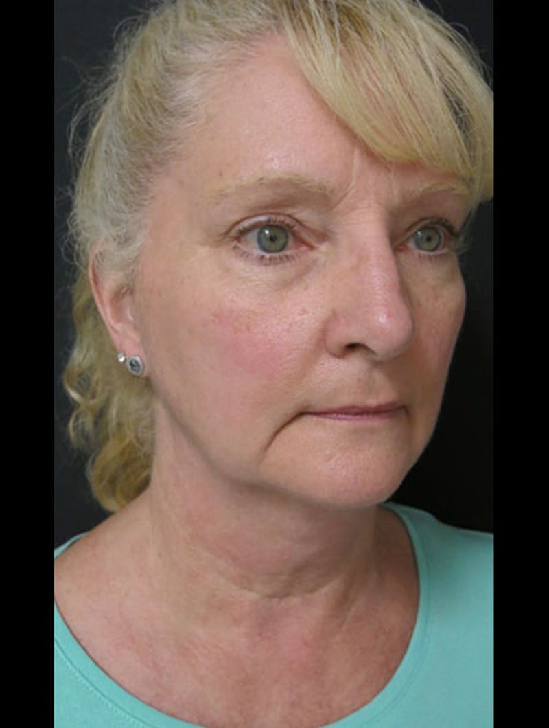 Facial Fat Grafting Before & After Gallery - Patient 122909087 - Image 3