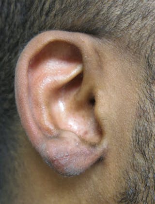 Ear Lobe Repair and Ear Reconstruction Before & After Gallery - Patient 122909079 - Image 6