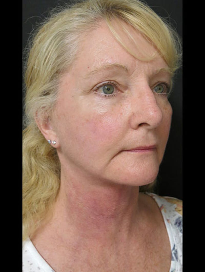 Facial Fat Grafting Before & After Gallery - Patient 122909087 - Image 4