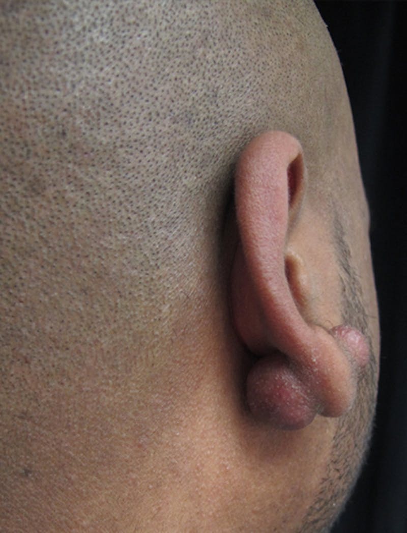 Ear Lobe Repair and Ear Reconstruction Before & After Gallery - Patient 122909079 - Image 7