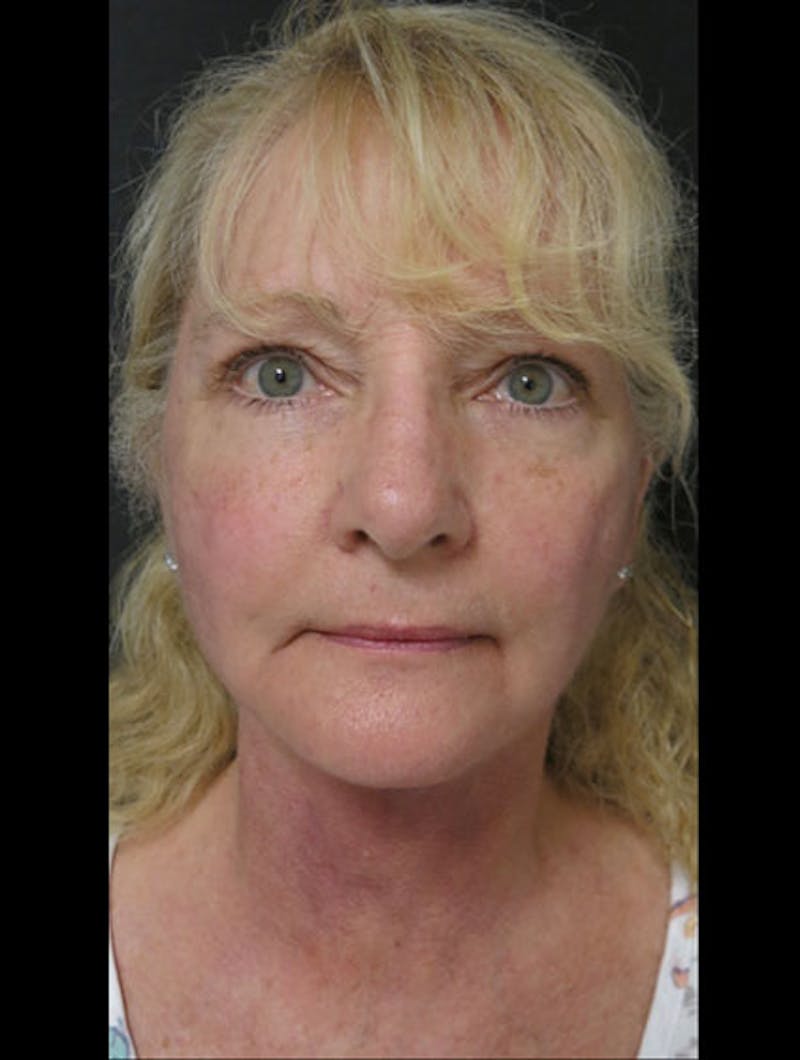 Facial Fat Grafting Before & After Gallery - Patient 122909087 - Image 6